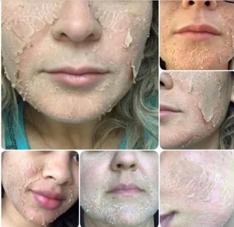Peeling Retinoico Yeloow 15g na internet
