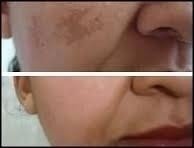Peeling Fator De Crescimento 30 Ml - Clean Face Skin