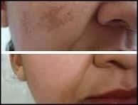 Ácido Retinóico 8% Peeling 10g + Sabonete Pré Peeling 60ml - Clean Face Skin