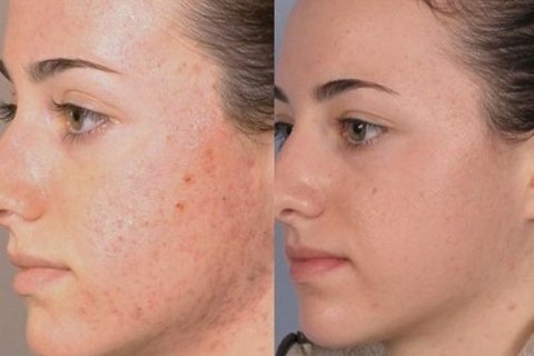 Peeling Ácido Glicólico 10% Gel Creme Toque Seco 30g na internet