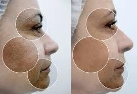 Ácido Retinóico 8% Peeling 10g + Sabonete Pré Peeling 60ml - loja online