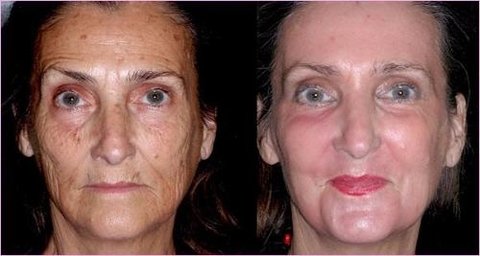 Kit 3 Sabonetes Gel Pré Peeling 150g Cada na internet
