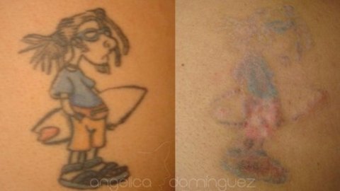 Peeling Ácido Removedor De Tatuagens E Micro Pigmentações - Clean Face Skin
