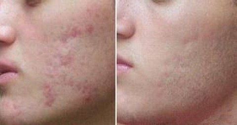 Imagem do Ácido Retinóico 5% 15g Puro + Sabonete Pré Peeling