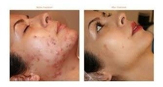 Imagem do Acido Retinóico 30% 20g Profissional+ Sabonete Peeling 60ml
