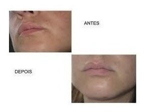 10 Ácidos Retinóico 30% Profissional + 10 Sabonetes 60ml na internet