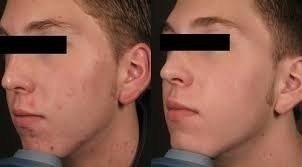 Ácido Retinóico 30% Profissional + Sabonete Peeling 60ml - loja online
