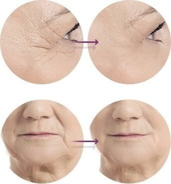 Acido Retinoico 15% Puro + Sabonete Pré E Pós Peeling 60ml - loja online