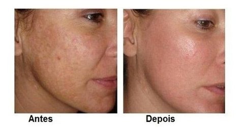 Ácido Tricloroacético 80% 30 Ml - Clean Face Skin