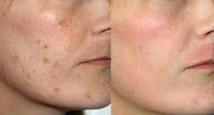 Sabonete Ácido Hidroquinona 30%( Acne, Manchas Rugas)200ml - loja online