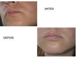 Ácido Salicílico 10% Com Ácido Lactico 5% 30ml + Sabonete na internet