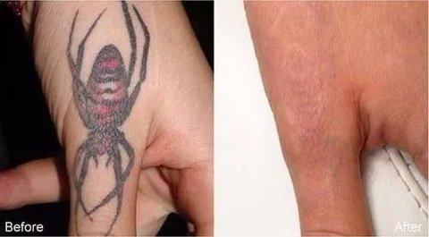 Peeling Ácido Removedor De Tatuagens E Micro Pigmentações na internet