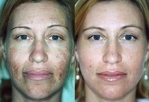 Ácido Glicólico 30% 30g Peeling Clareador + Sabonete 110ml - loja online