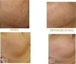 Hidroquinona Clareador 10% 30g + Sabonete Peeling 60ml - Clean Face Skin