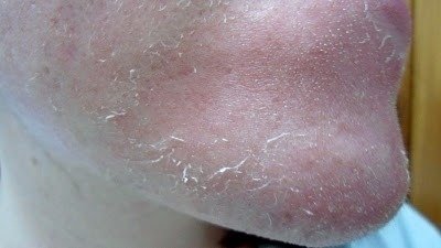 Acido Retinóico 30% Profissional+ Sabonete Pré Peeling 60ml - loja online