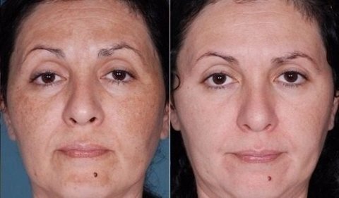 Ácido Retinóico 50% Puro Profissional + Sabonete Peeling na internet