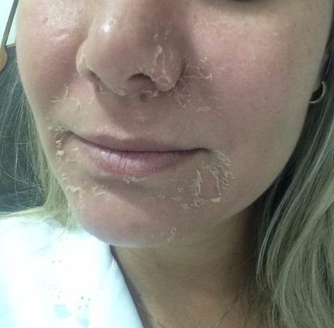Ácido Retinoico 30 % Puro + Peeling Resorcina 10%+ Sabonete - loja online
