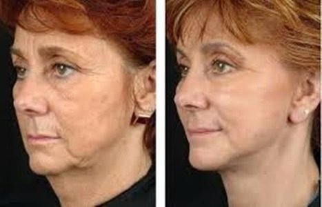 Acido Retinóico 10% Puro + Sabonete Peeling 60ml + Protetor - comprar online