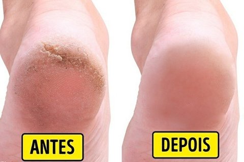 Creme Para Afinar Os Pés - Dermopés - comprar online
