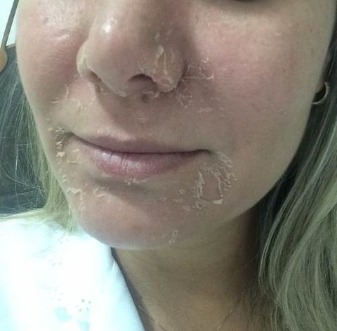 Ácido Retinoico 20% 15g Puro + Sabonete Pré Peeling - loja online