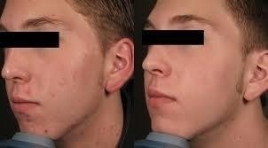 Imagem do Ácido Mandélico 40% 30ml + Neutralizante 60g