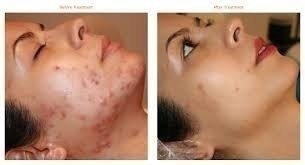 Imagem do Ácido Retinoico 15% Puro + Sabonete Pré Peeling 110ml
