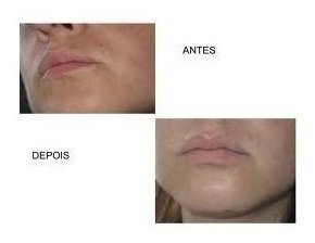 Alpha Arbutin Peeling Clareador 30ml 20% na internet