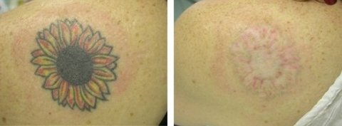 Peeling Ácido Removedor De Tatuagens E Micro Pigmentações - loja online