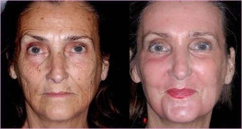 Ácido Retinóico 5% 15g Puro + Sabonete Pré Peeling - comprar online