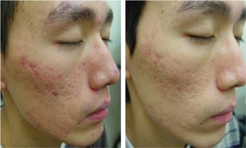 Ácido Glicolico Peeling 3d 30ml + Sabonete + Neutralizante - loja online