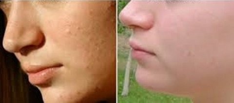 Ácido Azeláico 40% + Sabonete Pré Peeling ( Anti Acneico ) - Clean Face Skin