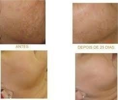 Hidroquinona 30% Despigmentante 60ml Solução na internet
