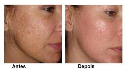 Imagem do Ácido Retinóico 30% Cor Base+ Vitamina C+ Sabonete+ Jesnner