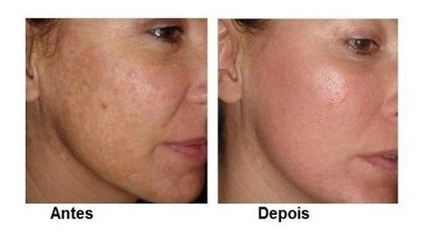 2 Ácidos Salicílico 30% Peles Oleosas 30ml + Sabonete 60ml na internet