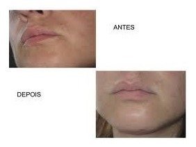Acido Retinoico 1% 30g + Sabonete Peeling na internet
