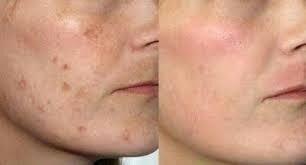 Ácido Glicólico 30% 30g Peeling Clareador + Sabonete 110ml na internet