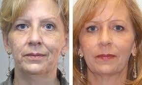 Ácido Retinóico 0,50% 30g Uso Diário - Clean Face Skin