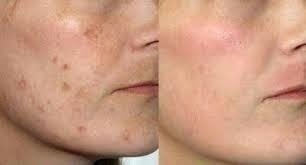 Imagem do Ácido Retinóico 10% Ácido Kojico 10% + Sabonete Pré Peeling