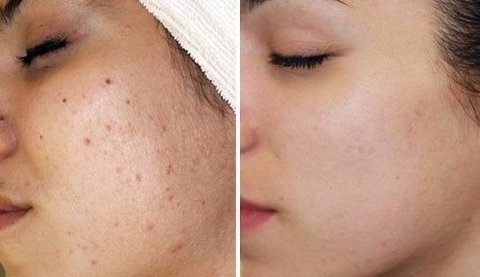 Peeling Ácido Glicólico 10% Gel Creme Toque Seco 30g - comprar online