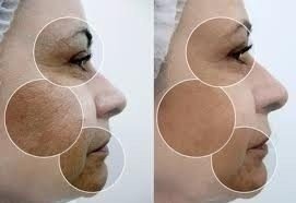 Peeling Fator De Crescimento 30 Ml - loja online