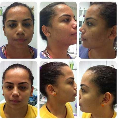 Imagem do Ácido Retinoico 30 % Puro + Peeling Resorcina 10%+ Sabonete