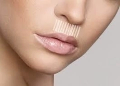 BOTOX MR - Laboratorio Allergan TERCIO INFERIOR DEL ROSTRO - - comprar online