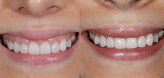 BOTOX MR - LABORATORIO ALLERGAN - SONRISA GINGIVAL - - comprar online