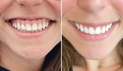 BOTOX MR - LABORATORIO ALLERGAN - SONRISA GINGIVAL -