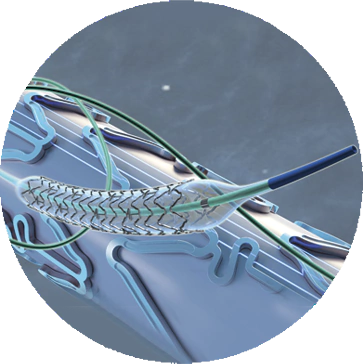 STENT CORONARIO L/ RAPAMICINA MICROPORT 2.50 x 33
