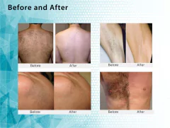 FG2000 NUEVO EQ. LASER DIODO DEPILACION DEFINITIVA - comprar online