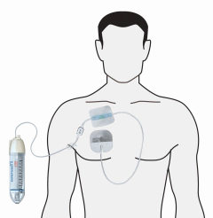 INFUSOR SUREFUSER 100cc dos dias 2ml/Hora NIPRO - comprar online