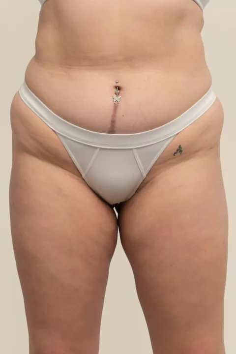 Colaless Venus Blanco - Archetype
