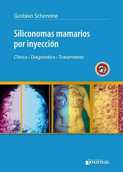 Siliconomas mamarios por inyeccion - Schenone - Ediciones Journal